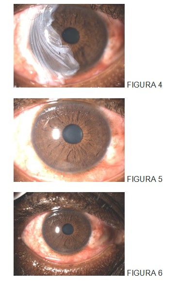 trasplante_membrana_amniotica/quemaduras_ojo_oftalmologia