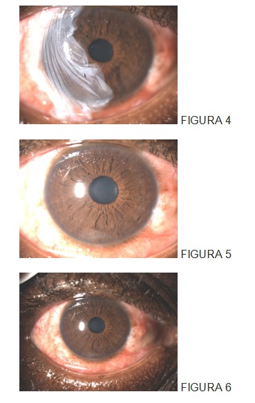 trasplante_membrana_amniotica/quemaduras_ojo_oftalmologia trasplante_membrana_amniotica/quemaduras_ojo_oftalmologia