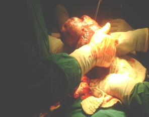 tumor_caso_Brenner/cirugia_extirpacion_tratamiento