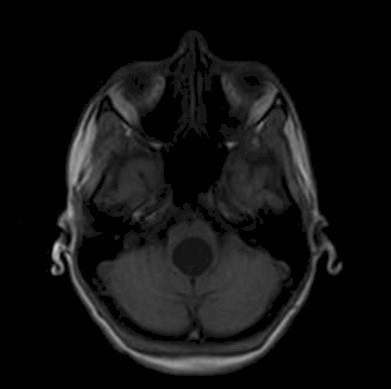 caso_astrocitoma_pilocitico/vista_axial_tumor