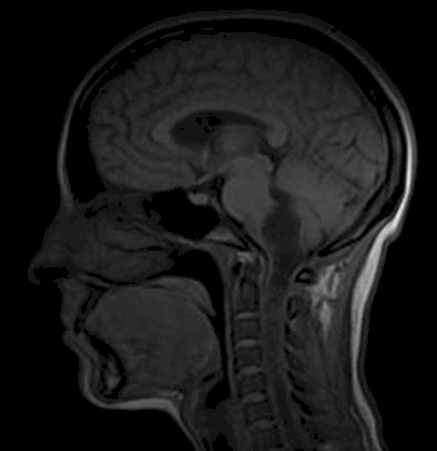 caso_astrocitoma_pilocitico/vista_sagital_tumor caso_astrocitoma_pilocitico/vista_sagital_tumor