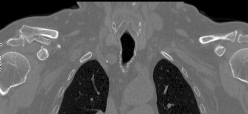 caso_duplicacion_clavicular/TAC_hombro_imagen