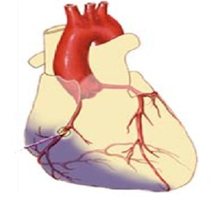 rehabilitacion_infarto_miocardio/necrosis_miocardica_isquemia
