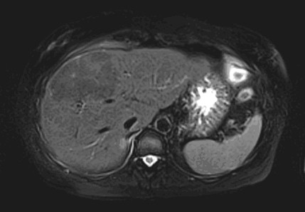 adenoma_hepatico_higado/RMN_contraste_intravenoso