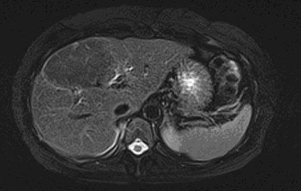 adenoma_hepatico_higado/RM_gadodexato_disodio_iv