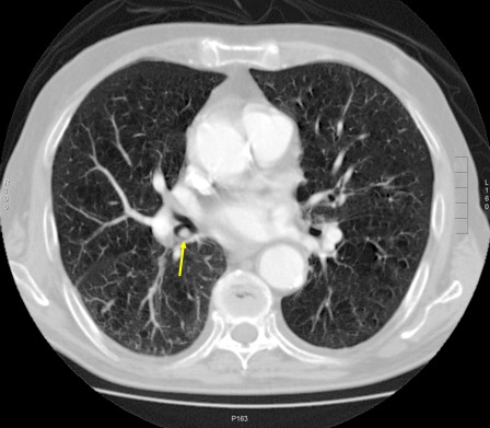 cuerpo_bronquial_obstruccion/hueso_aceituna_broncoaspirado