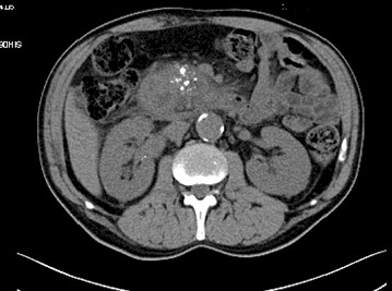 distrofia_quistica_duodenal/TAC_pancreatitis_cronica