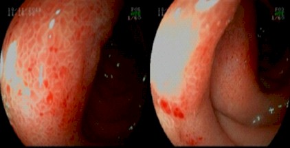 distrofia_quistica_duodenal/duodeno_edematoso_endoscopia