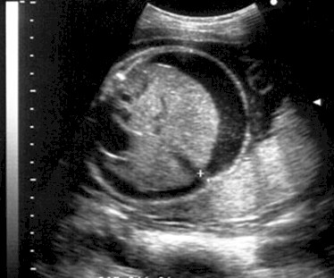 embarazo_atencion_primaria/ecografia_fetal_embarazadas