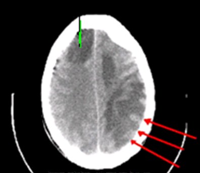 enfermedad_cerebrovascular_isquemica/TAC_craneal_isquemia_ictus