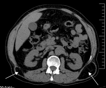 hernia_lumbar_grasa/TAC_abdominal_corte