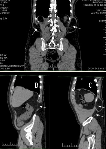 hernia_lumbar_grasa/TAC_toracoabdominal_sagital hernia_lumbar_grasa/TAC_toracoabdominal_sagital