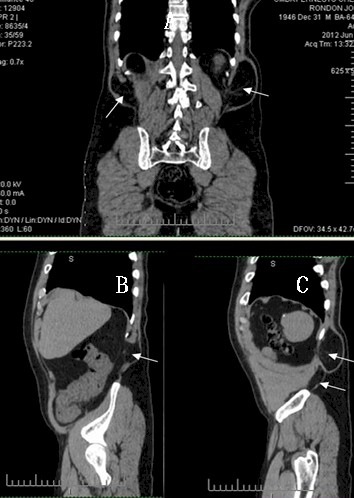 hernia_lumbar_grasa/TAC_toracoabdominal_sagital