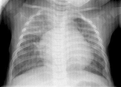 lactante_CIV_cardiopatia/comunicacion_interventricular_cardiomegalia