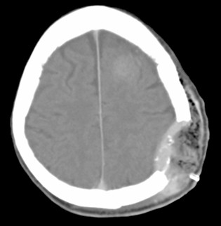 metastasis_carcinoma_renal/TAC_infiltracion_craneo metastasis_carcinoma_renal/TAC_infiltracion_craneo