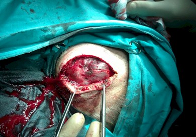 metastasis_carcinoma_renal/tratamiento_quirurgico_cirugia