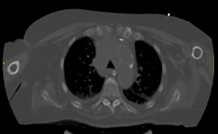 obstruccion_via_aerea/adenocarcinoma_traquea_TAC