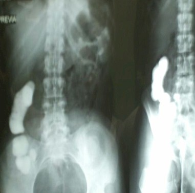 sindrome_currarino_malformacion/RX_lumbosacra_hemisacro