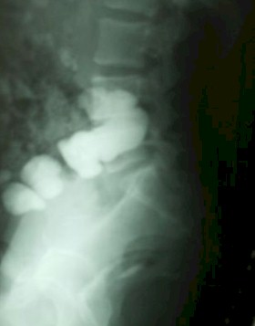 sindrome_currarino_malformacion/Rx_lumbosacra_lateral