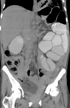 sindrome_currarino_malformacion/TAC_abdomen_ovario
