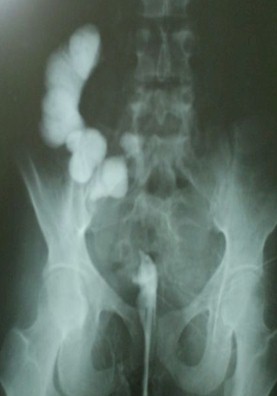 sindrome_currarino_malformacion/hemisacro_sacro_cimitarra