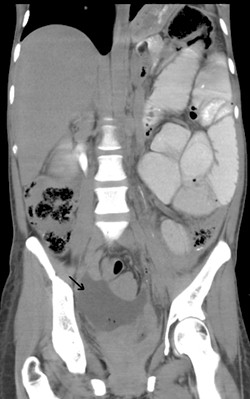 sindrome_currarino_malformacion/teratoma_quistico_ovario