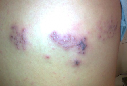 virus_herpes_zoster/vesiculas_dermatoma_toracico virus_herpes_zoster/vesiculas_dermatoma_toracico