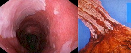 esofago_barret_ERGE/biopsia_metaplasia_endoscopia