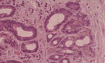 esofago_barret_ERGE/carcinoma_adenocarcinoma_diferenciado