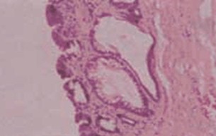 esofago_barret_ERGE/displasia_metaplasia_intestinal