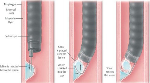 esofago_barret_ERGE/reseccion_mucosa_endoscopia