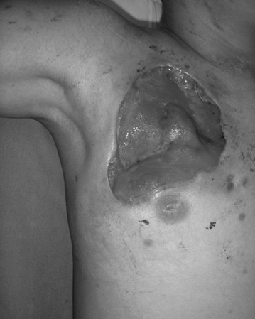 fascitis_necrotizante_varicela/fascitis_necrosante_pectoral