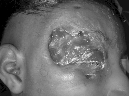 fascitis_necrotizante_varicela/injerto_cutaneo_total
