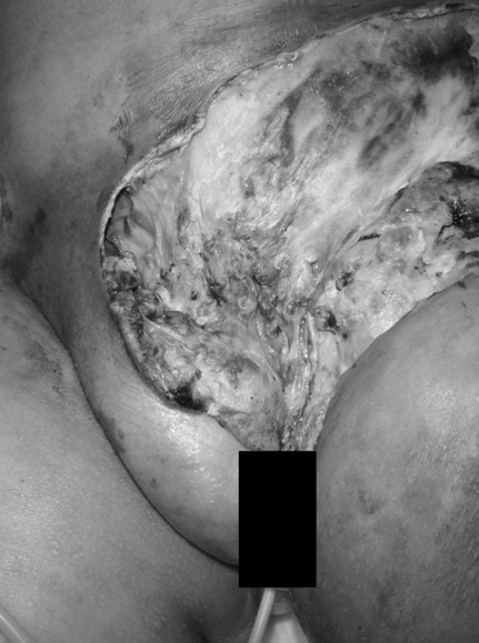 fascitis_necrotizante_varicela/necrosis_exudado_inguinal
