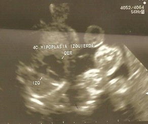 hipoplasia_cavidades_izquierdas/ecografia_ecocardiografia_congenita