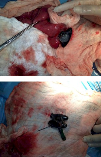 caso_obstruccion_intestinal/cirugia_extraccion_material