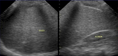 complicaciones_cirrosis_hepatica/esplenomegalia_congestiva_ecografia