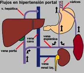 complicaciones_cirrosis_hepatica/sindrome_hipertension_portal
