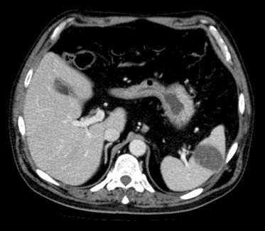 complicaciones_endocarditis_infecciosa/TAC_infarto_esplenico