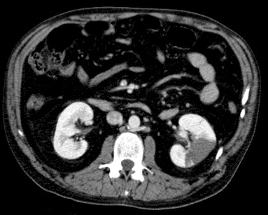 complicaciones_endocarditis_infecciosa/TAC_infarto_renal