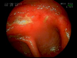 endoscopia_colitis_infecciosa/enfermedad_inflamatoria_intestinal