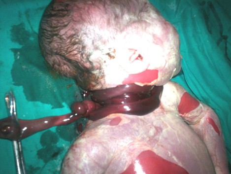 muerte_cordon_umbilical/circular_circulares_vuelta muerte_cordon_umbilical/circular_circulares_vuelta