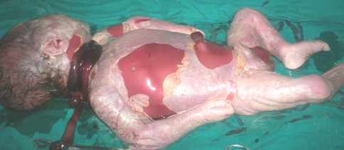 muerte_cordon_umbilical/obito_fetal_nonato muerte_cordon_umbilical/obito_fetal_nonato