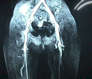 oclusion_arterial_aguda/arteriografia_contraste_inflamacion