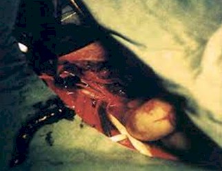 oclusion_arterial_aguda/embolectomia_arteria_femoral