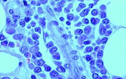 revision_mieloma_multiple/histologia_anatomia_patologica