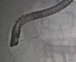 traumatismo_toracoabdominal_cerrado/asas_intestinales_distendidas