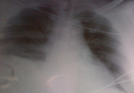 traumatismo_toracoabdominal_cerrado/radiografia_de_torax