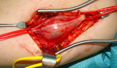 Schwannoma_nervio_mediano/cirugia_tumor_exposicion