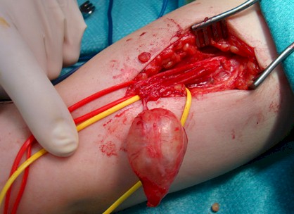 Schwannoma_nervio_mediano/extirpacion_tumor_nervioso